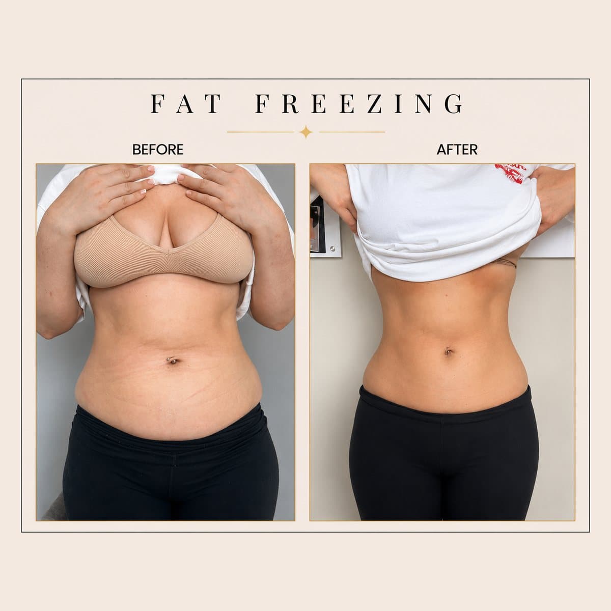 Fat Freezing before and after at Totally Transformed Newcastle, abdomen
