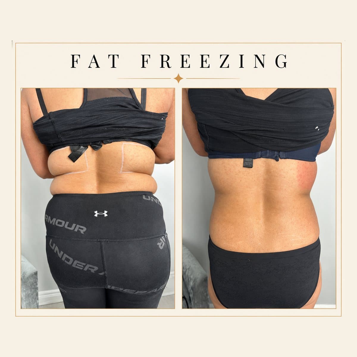 Fat Freezing before and after at Totally Transformed Newcastle, back and bra fat