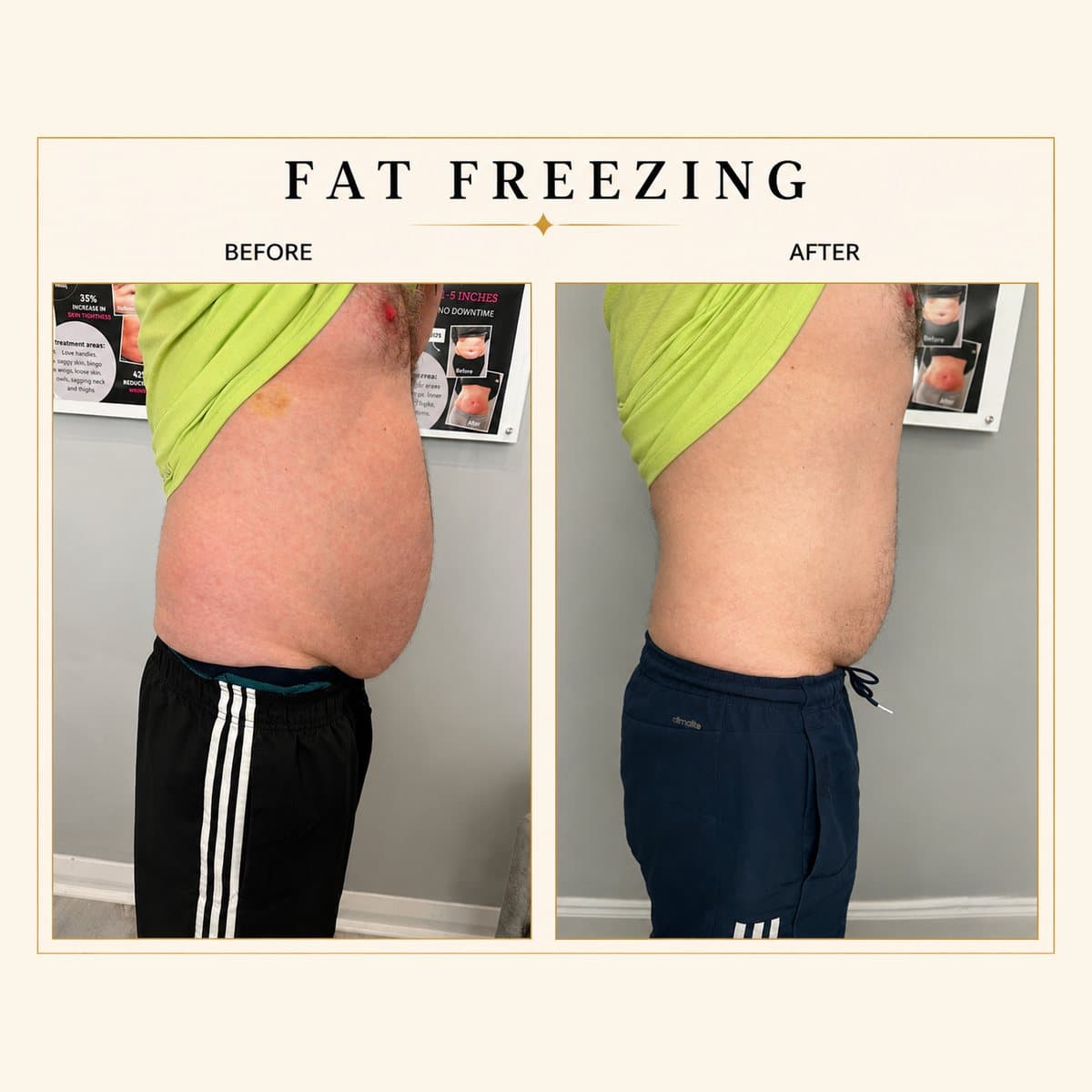 Fat Freezing before and after at Totally Transformed Newcastle, men’s abdomen
