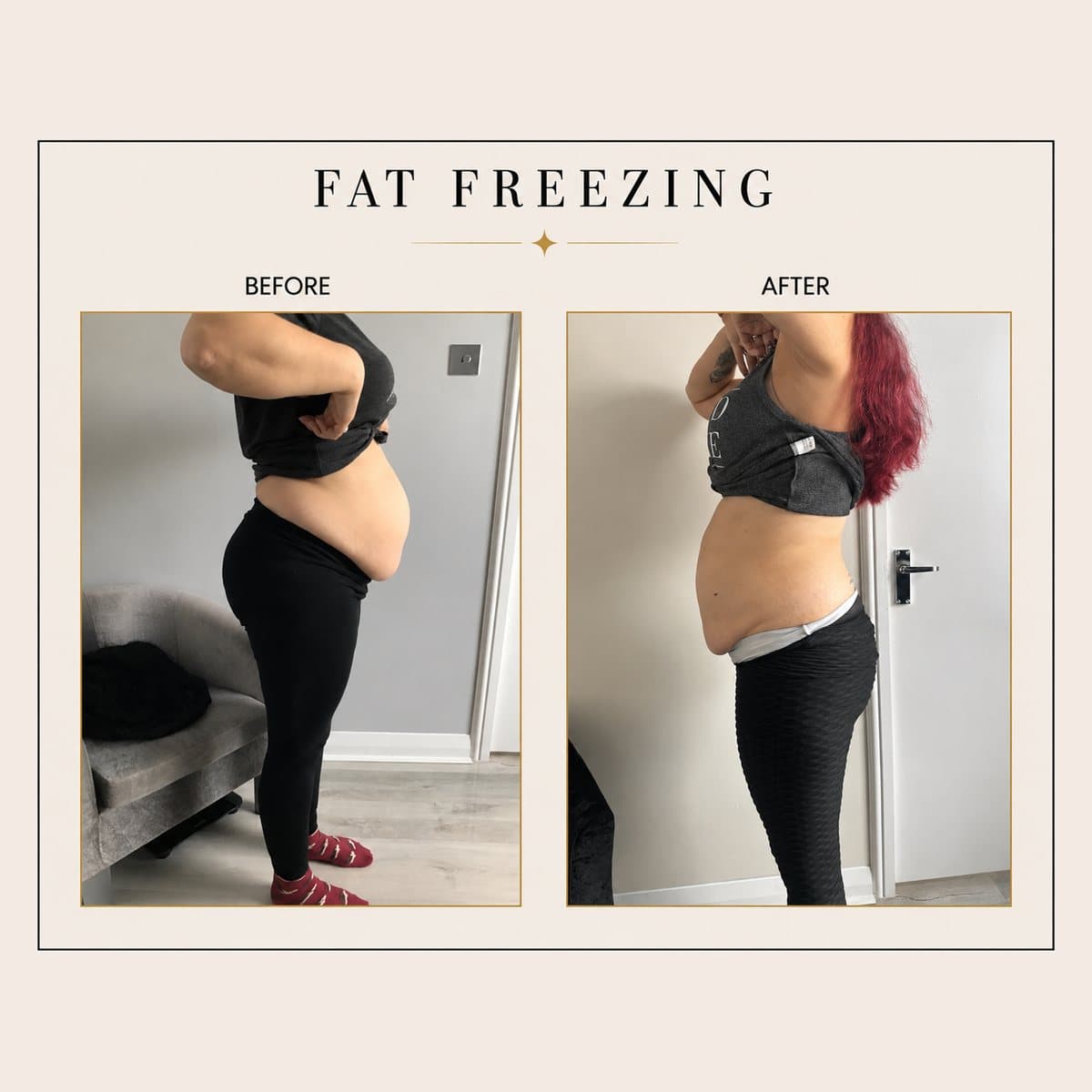 Fat Freezing before and after at Totally Transformed Newcastle, waist and flanks