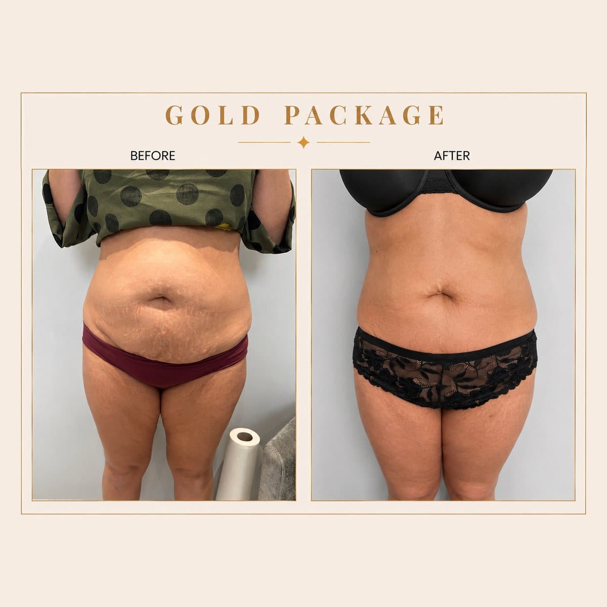 Ultimate Body Transformation before and after at Totally Transformed Newcastle, gold package