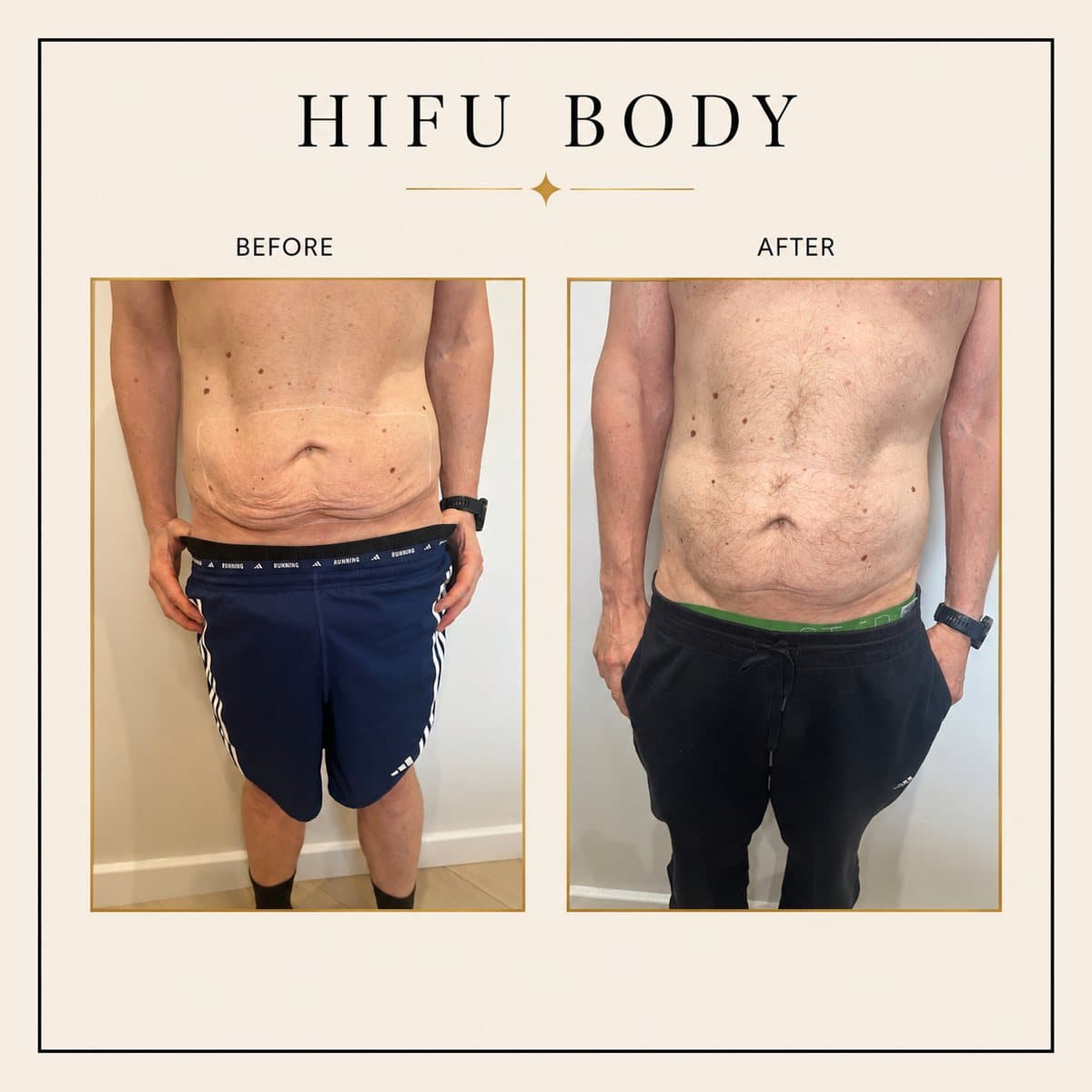 HIFU Body before and after at Totally Transformed Newcastle, men’s abdomen