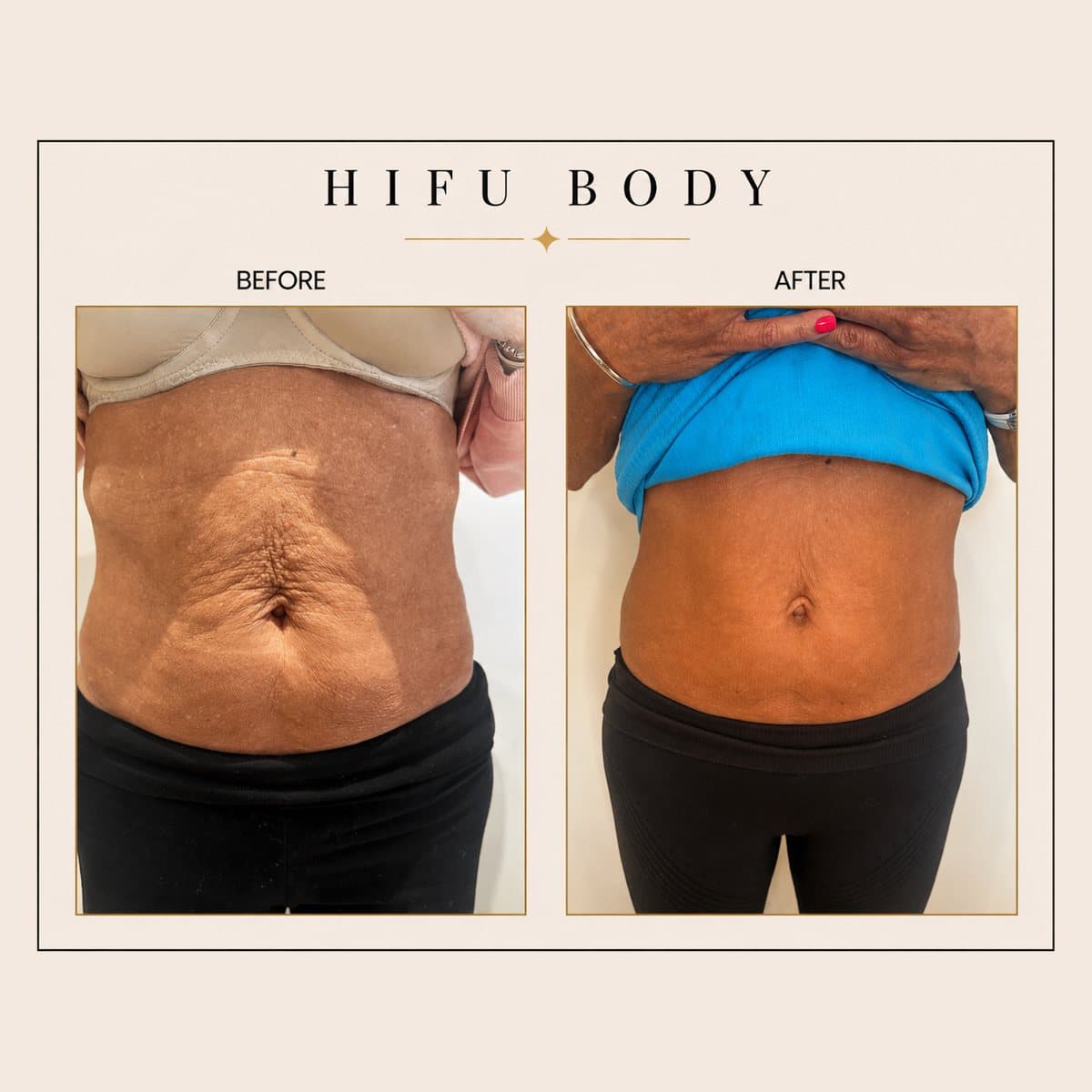 HIFU Body before and after at Totally Transformed Newcastle, loose abdominal skin