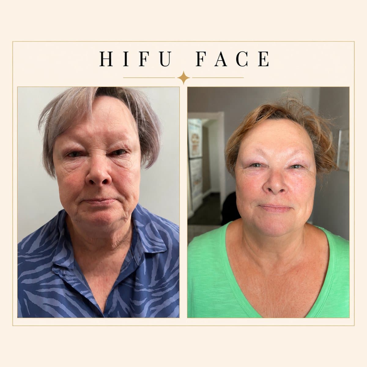 HIFU Ultra Facelift before and after at Totally Transformed Newcastle, eyes and jowls