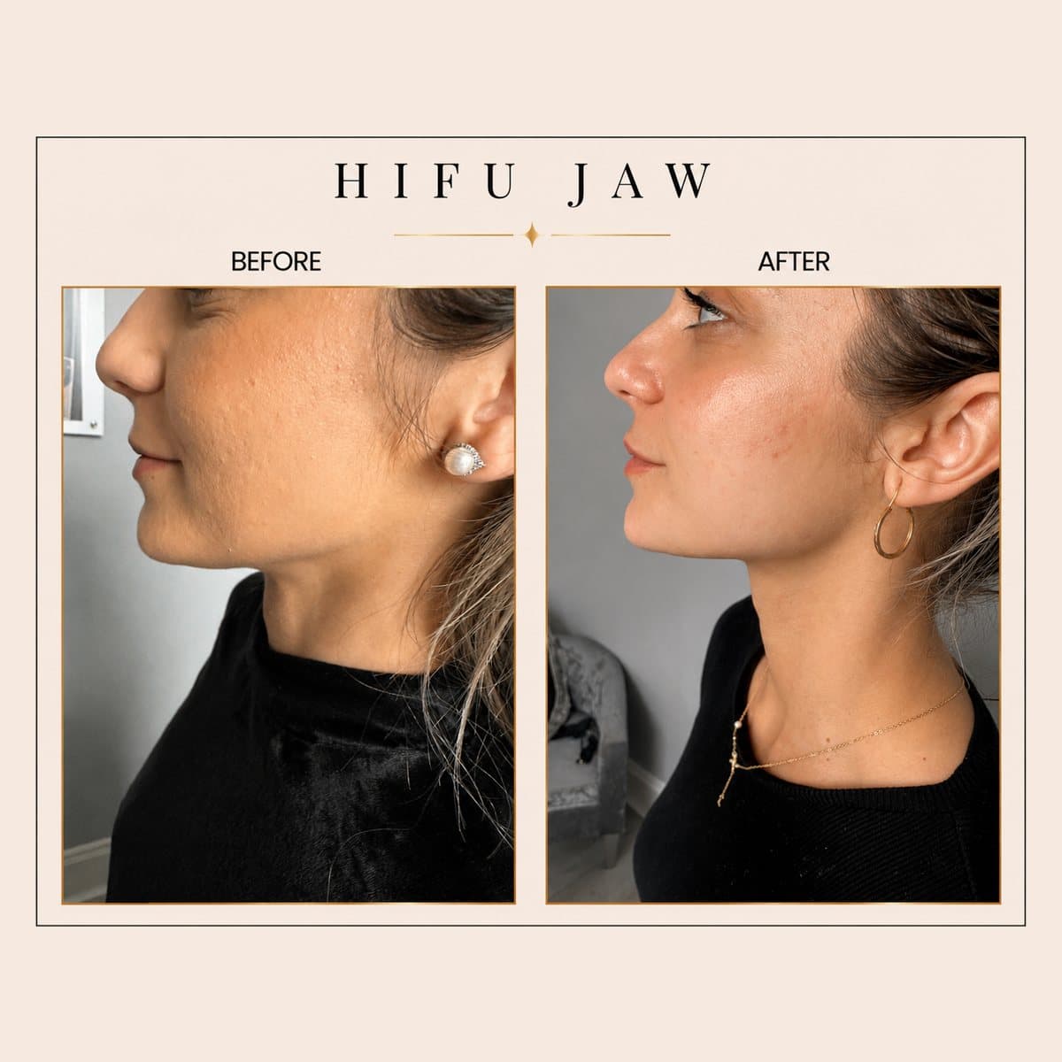 HIFU Ultra Facelift before and after at Totally Transformed Newcastle, jawline and skin texture
