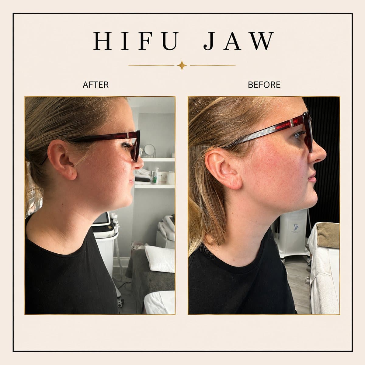HIFU Ultra Facelift before and after at Totally Transformed Newcastle, jawline