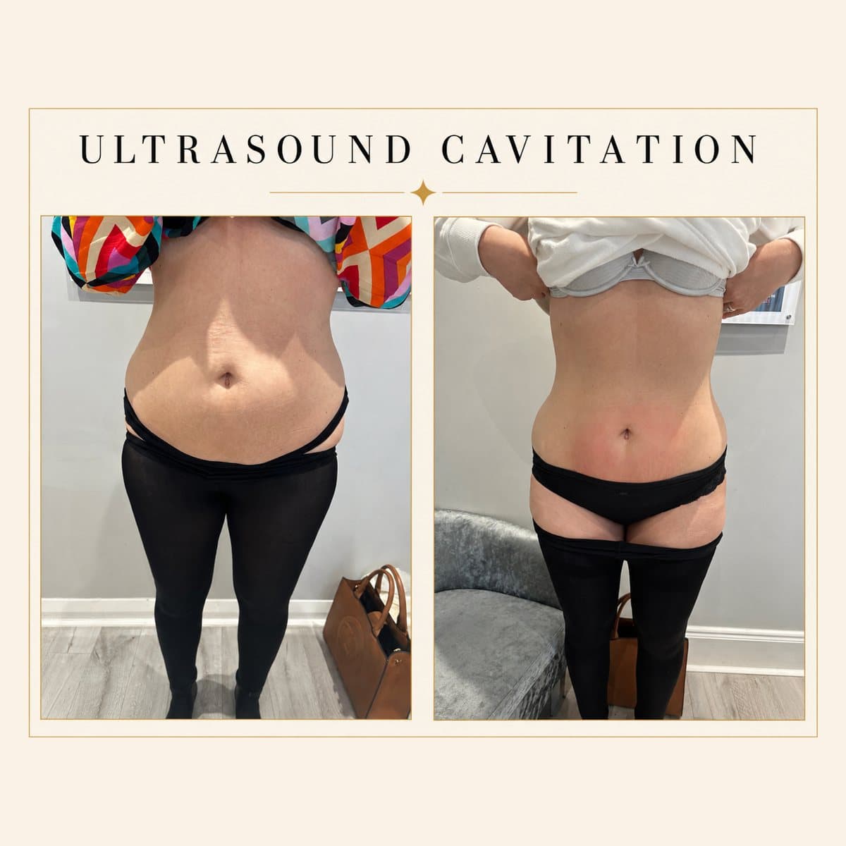 Ultrasound Cavitation before and after at Totally Transformed Newcastle, waist