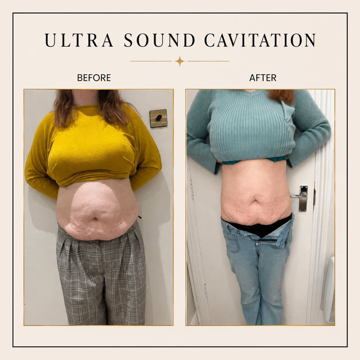 Ultrasound Cavitation before and after at Totally Transformed Newcastle, abdomen